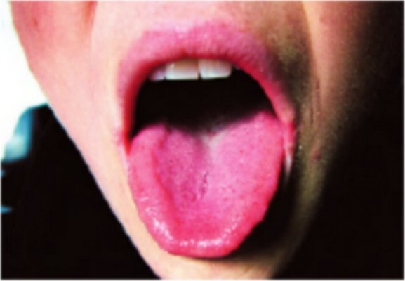 Bords de la langue gonflés, zone de la rate
