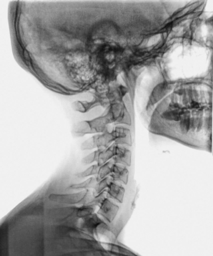 Crâne aux rayons X du côté droit