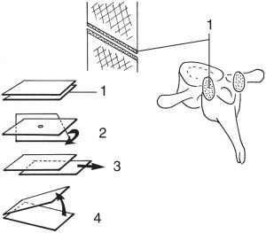 Articulation plane (1, surfaces en place ; 2, rotation ; 3, glissement, deux axes possibles ; 4, baillement, deux axes possibles, ou flexion)