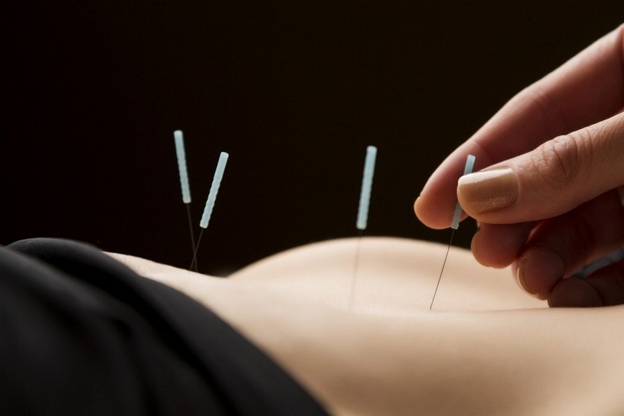 Illustration des aiguilles de l'acupuncture